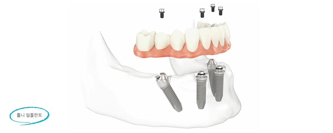 틀니 임플란트