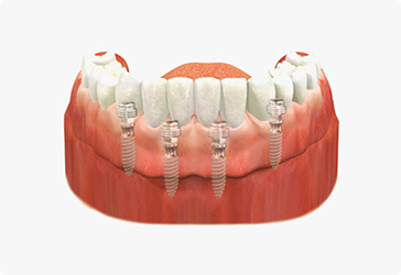 임플란트 틀니 고정