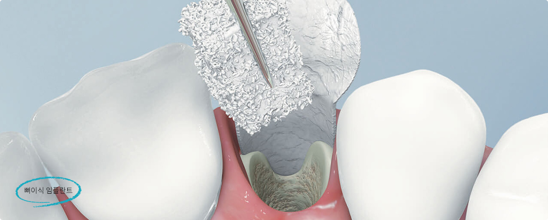 뼈이식 임플란트